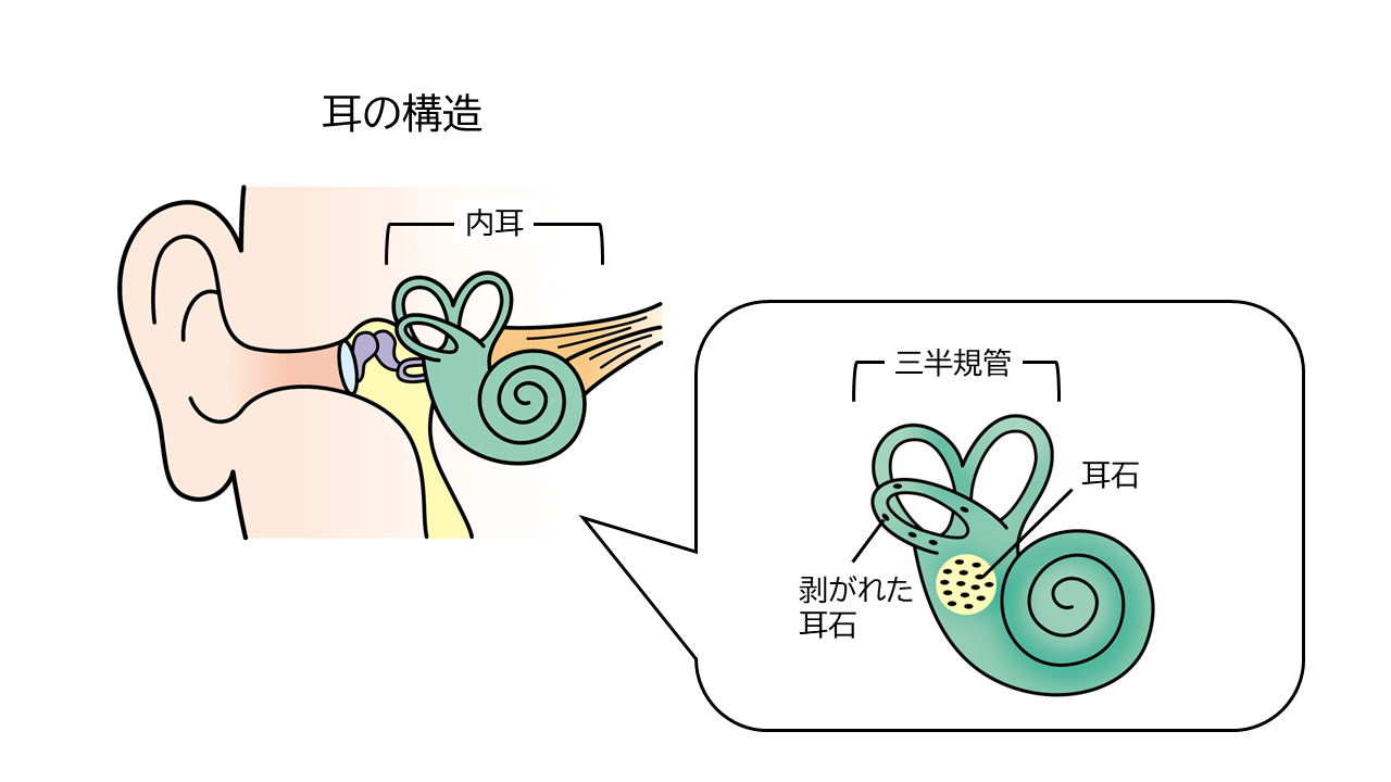 耳の構造の説明図。良性発作性頭位めまい症は耳石の一部がはがれ三半規管に入り込むことでおこります。