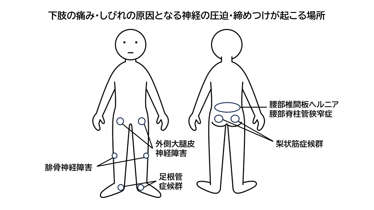 下肢の神経痛が起こる場所