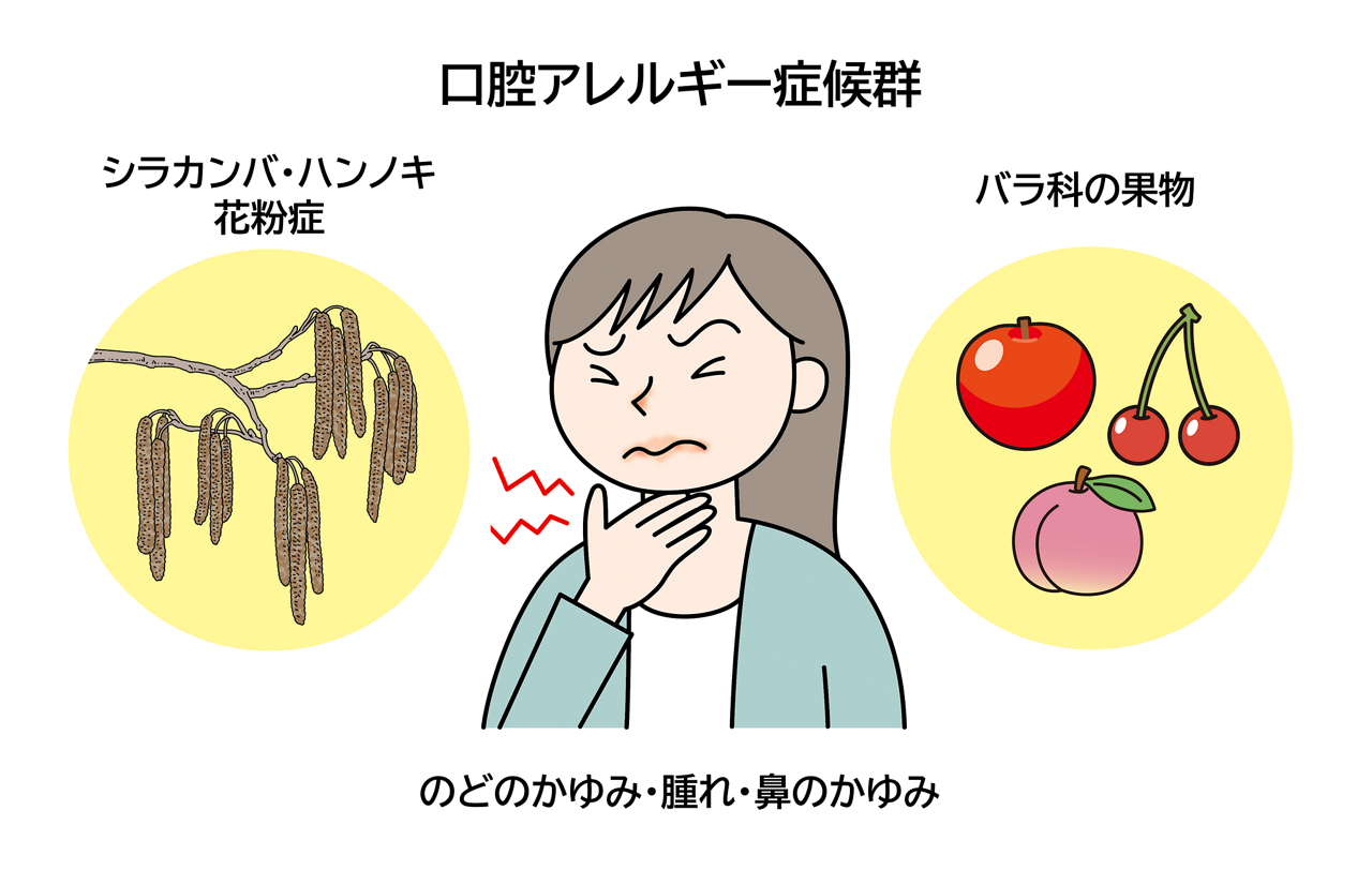 口腔アレルギー症候群