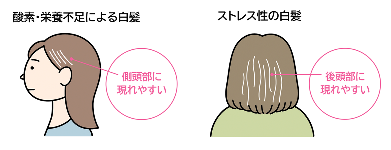 「酸素・栄養不足の白髪」と「ストレス白髪」の特徴。酸素・栄養不足による白髪は側頭部に現れやすく、ストレス性の白髪は後頭部に現れやすい。