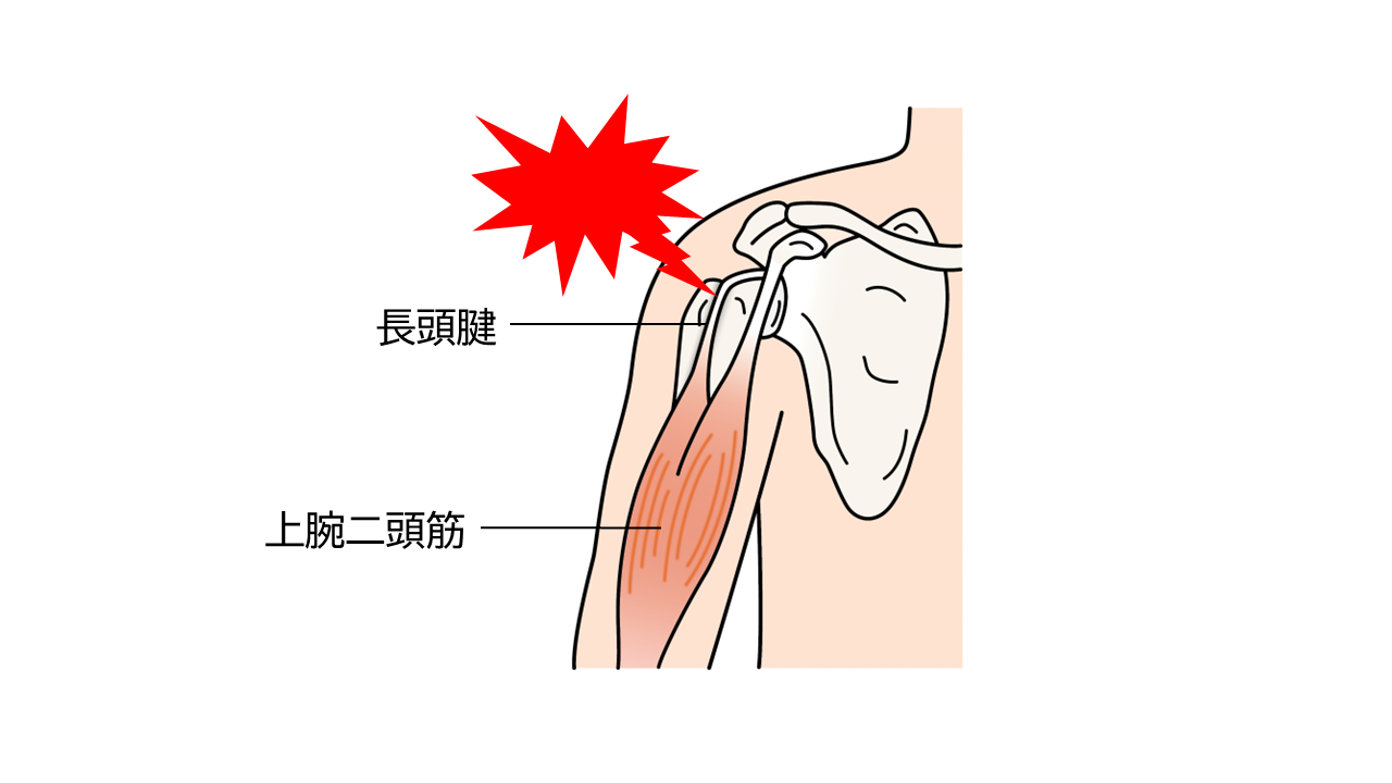 腱鞘炎｜原因・症状・治し方・対処法・予防法｜大正健康ナビ｜大正製薬