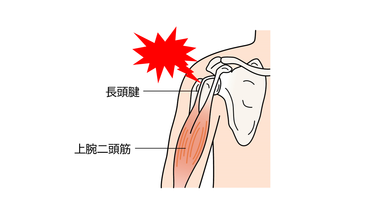 上腕二頭筋長頭腱炎は、スポーツや仕事などによる肩や肘の使い過ぎによって長頭腱と溝の間に摩擦が生じ、炎症が起こります。