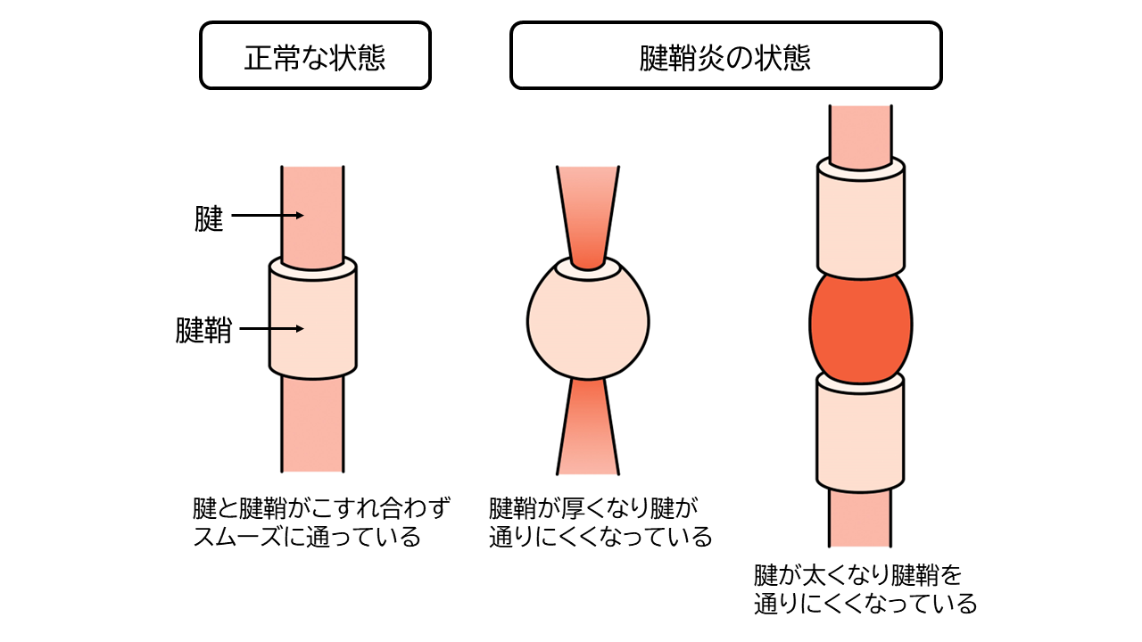 腱と腱鞘の正しい状態と腱鞘炎の状態比較。正常な状態は、腱と腱鞘がこすれ合わずスムーズに通っているが、腱鞘炎の状態では、腱鞘が厚くなり腱が通りにくくなっているか、腱が太くなり腱鞘を通りにくくなっている。