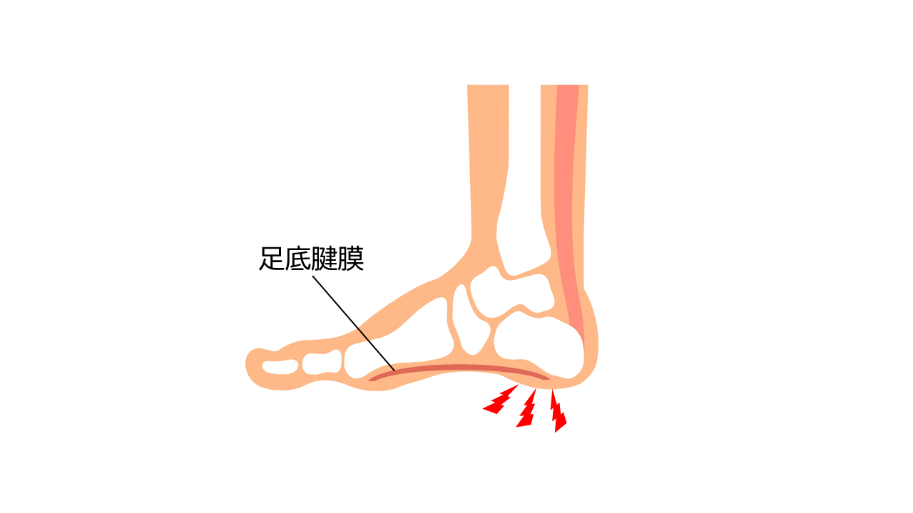 足底腱膜炎（そくていけんまくえん）は、かかとと足の指の付け根を結び、足の裏のアーチを支える足底腱膜という帯状の膜が炎症を起こすものです。