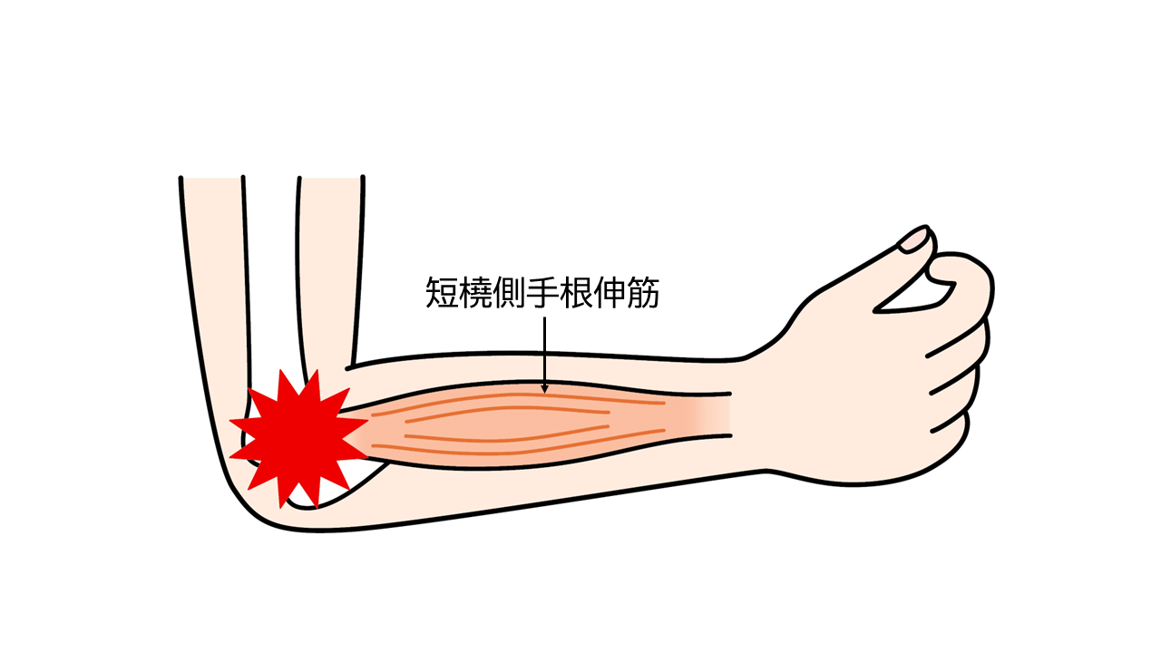 テニスひじは、手首や肘の使い過ぎによって、手首を伸ばす働きをする筋肉（短橈側手根伸筋：たんとうそくしゅこんしんきん）の先端の、肘の骨についている部分に炎症が起こり、肘の外側に痛みが生じるものです。