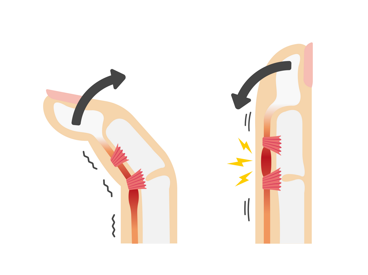 「ばね指」は太くなった腱が腱鞘を通過する際にひっかかって起こります。