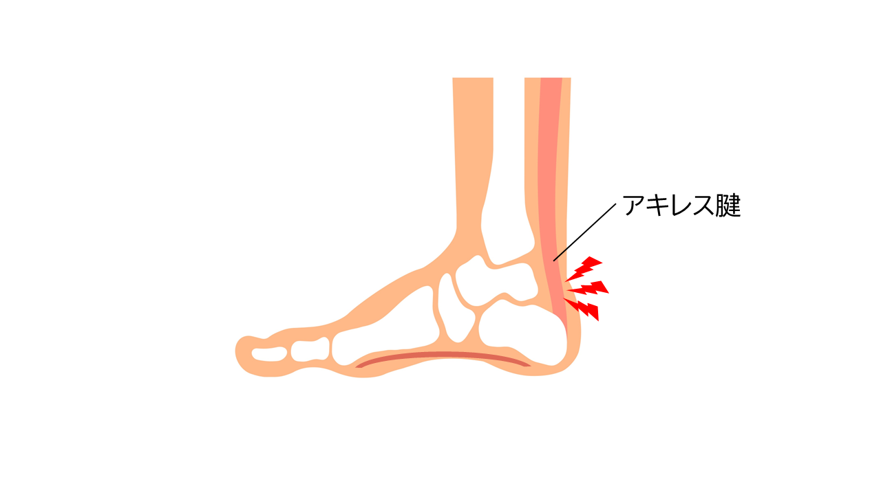 アキレス腱周囲炎は、足首の後ろ側にあるアキレス腱やアキレス腱を覆う腱周囲膜に炎症が生じ、痛みや腫れが現れます。