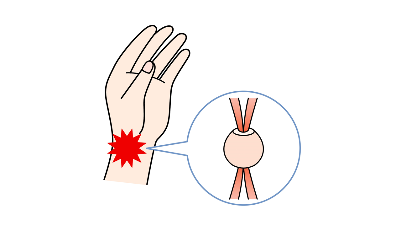 「ドケルバン病」は、手首の親指側にある親指を動かす２本の腱が通っている腱鞘が太くなって起こります。