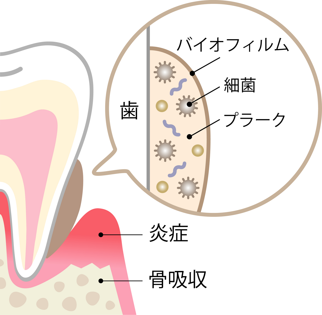 バイオフィルムのバリア機能によって、プラーク内部の細菌が唾液から守られ、産生される酸も増え続けてしまう