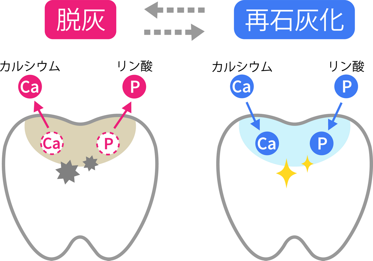 虫歯は歯の「脱灰」と「再石灰化」の均衡が崩れるとできる