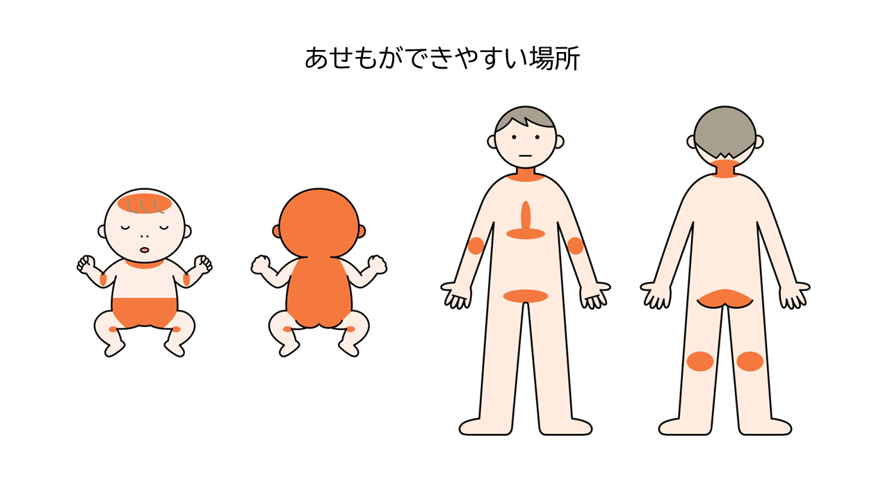 あせもができやすい場所は、汗をよくかいたり蒸れやすい首、胸、わきの下、肘（ひじ）の内側、肢のつけ根、膝（ひざ）の裏側などです。乳幼児は、おむつの箇所や背中、頭もできやすいです。