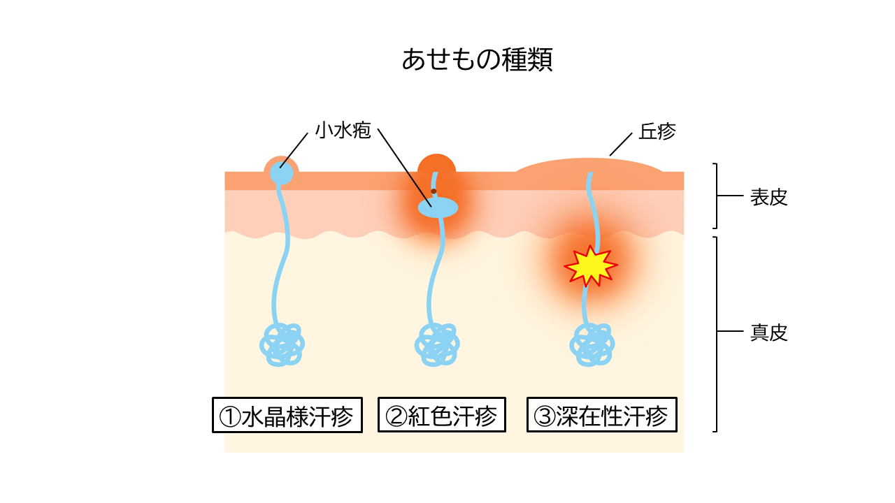 あせもは、次の３つの種類に分けられます。①赤みやかゆみはない「水晶様汗疹（すいしょうようかんしん）」②赤みとかゆみが出る「紅色汗疹（こうしょくかんしん）」③赤いポツポツが出る「深在性汗疹（しんざいせいかんしん）」
