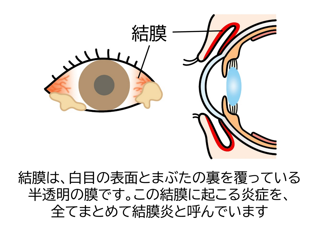 網膜は、白めの表面と瞼の裏を覆っている半透明の膜のこと。この角膜に起こる炎症を、全てまとめて結膜炎と呼ぶ。