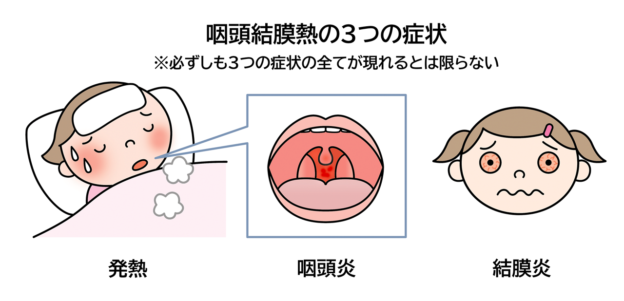 咽頭結膜熱の３つの症状。「発熱」「のどの腫れと痛み（咽頭炎）」「結膜炎」
