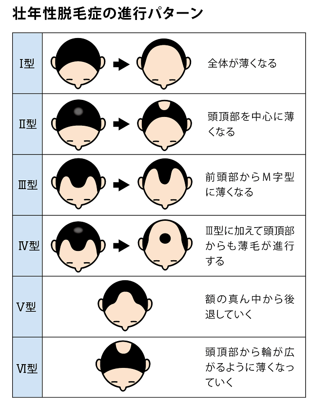 AGAの進行パターン6種類の紹介。Ⅰ型は全体が薄くなる、Ⅱ型は頭頂部を中心に薄くなる、Ⅲ型は前頭部からM字型に薄くなる、Ⅳ型はⅢ型に加えて頭頂部からも薄毛が進行する、Ⅴ型は額の真ん中から後退していく、Ⅵ型は頭頂部から輪が広がるように薄くなっていく。