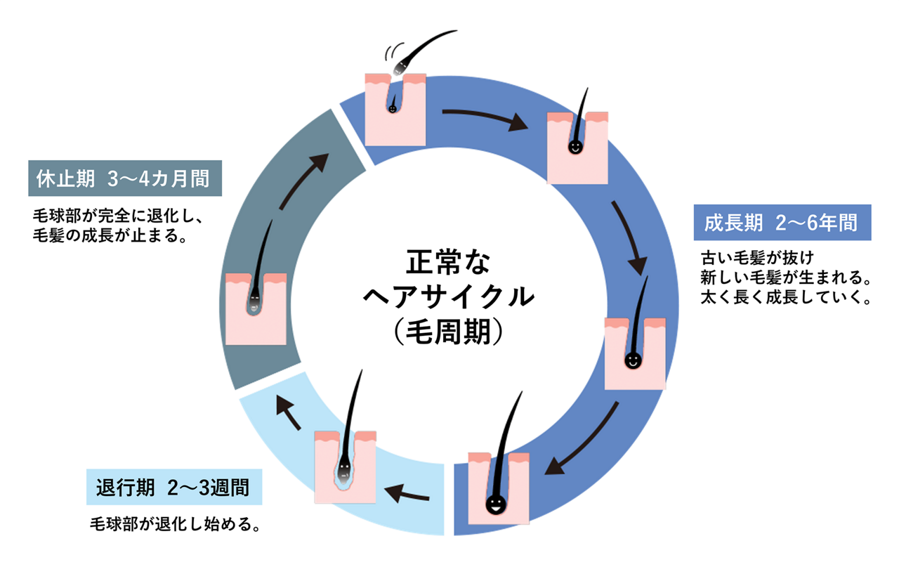 正常なヘアサイクル（毛周期）の図。成長期（2～6年）、古い毛髪が抜けて、新しい毛髪が生える。その後、太く長く成長する。退行期（2～3週間）、毛球部が退化し始める。休止期（3～4カ月間）、毛球部が完全に退化し、毛髪の成長が止まっている期間。