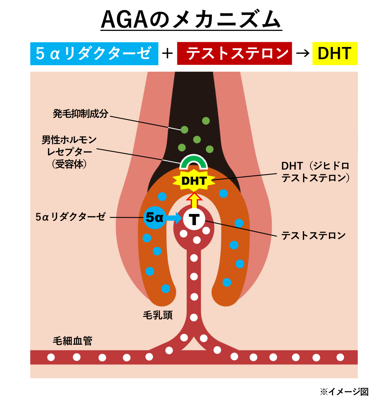 AGAのメカニズムのイメージ図。「5αリダクターゼ」と「テストステロン」が結合して「ジヒドロテストステロン（DHT）」という、より強力な男性ホルモンの一種に変換されます。DHTこそが、AGAの原因物質です。