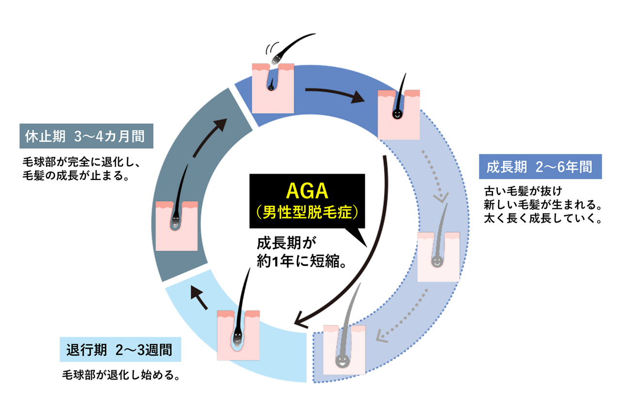 AGAのヘアサイクル（毛周期）の図。AGAになると、このヘアサイクルの回転が速くなり、通常２～6年ある成長期が約1年に短縮されてしまいます。