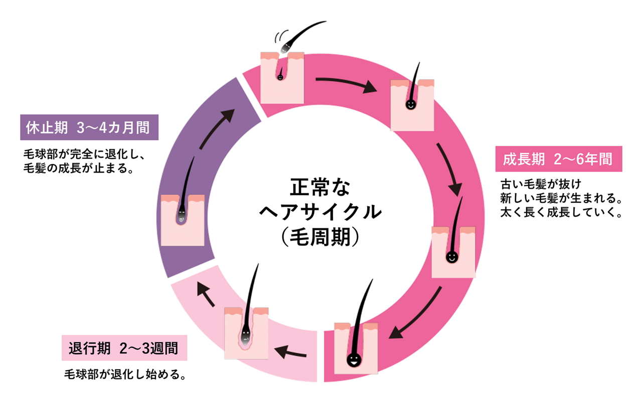 正常なヘアサイクル（毛周期）の図。成長期（2～6年）、古い毛髪が抜けて、新しい毛髪が生える。その後、太く長く成長する。退行期（2～3週間）、毛球部が退化し始める。休止期（3～4カ月間）、毛球部が完全に退化し、毛髪の成長が止まっている期間。