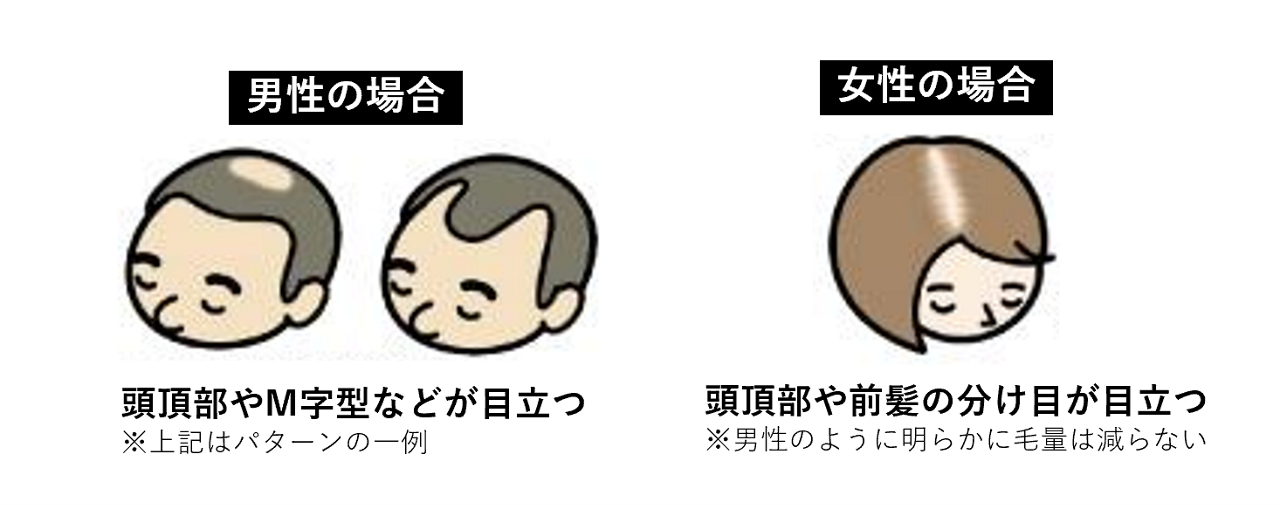 男性のAGAでは頭頂部や生え際のM字型が目立つ。女性のFAGA（FPHL）では、頭頂部や前髪の分け目が目立つ。女性は男性のように明らかに毛量は減らないことを示すイラスト。