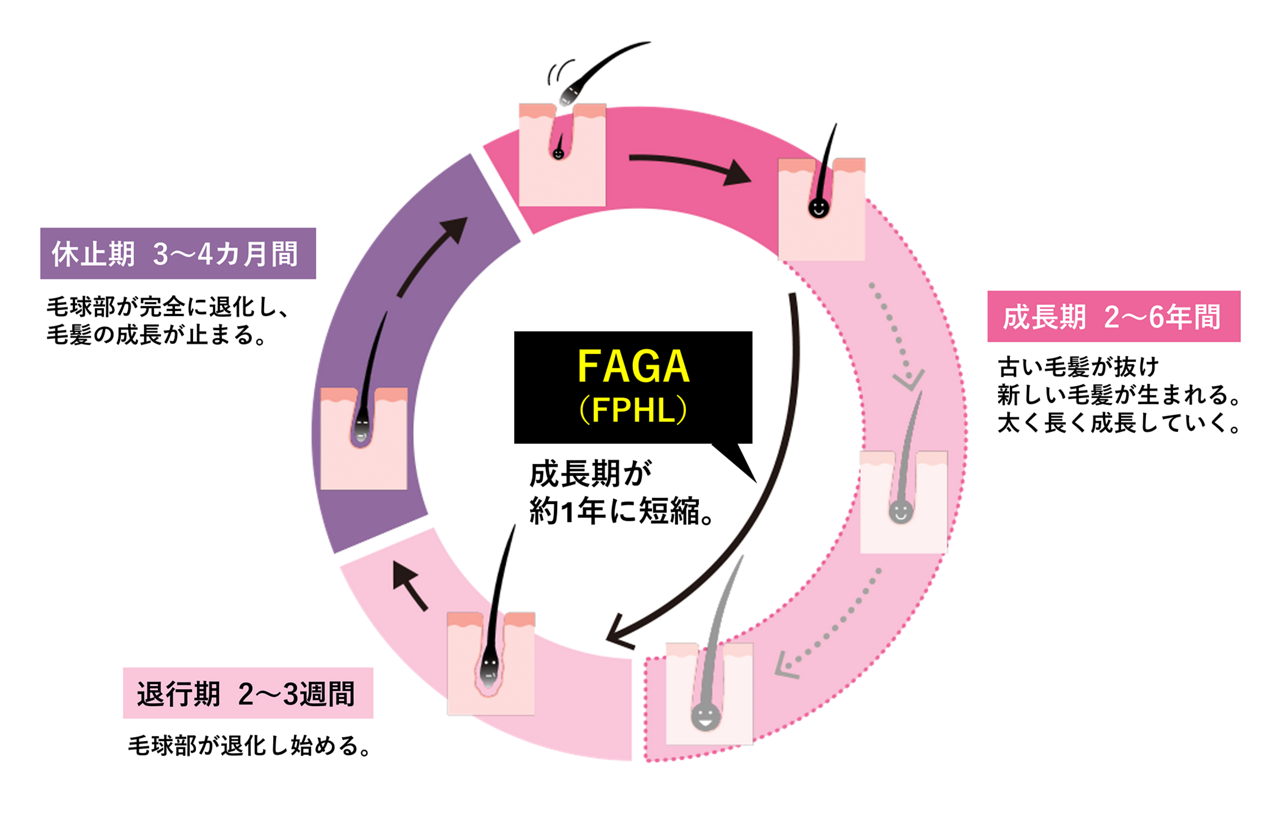 FAGA（FPHL）のヘアサイクル（毛周期）の図。FAGA（FPHL）になると、このヘアサイクルの回転が速くなり、通常２～6年ある成長期が約1年に短縮されます。