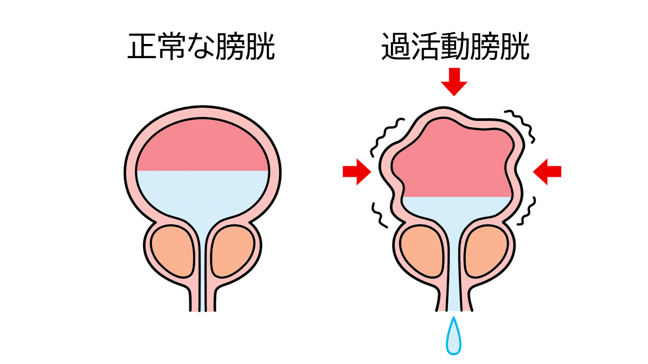 正常な膀胱と過活動膀胱のイメージイラスト