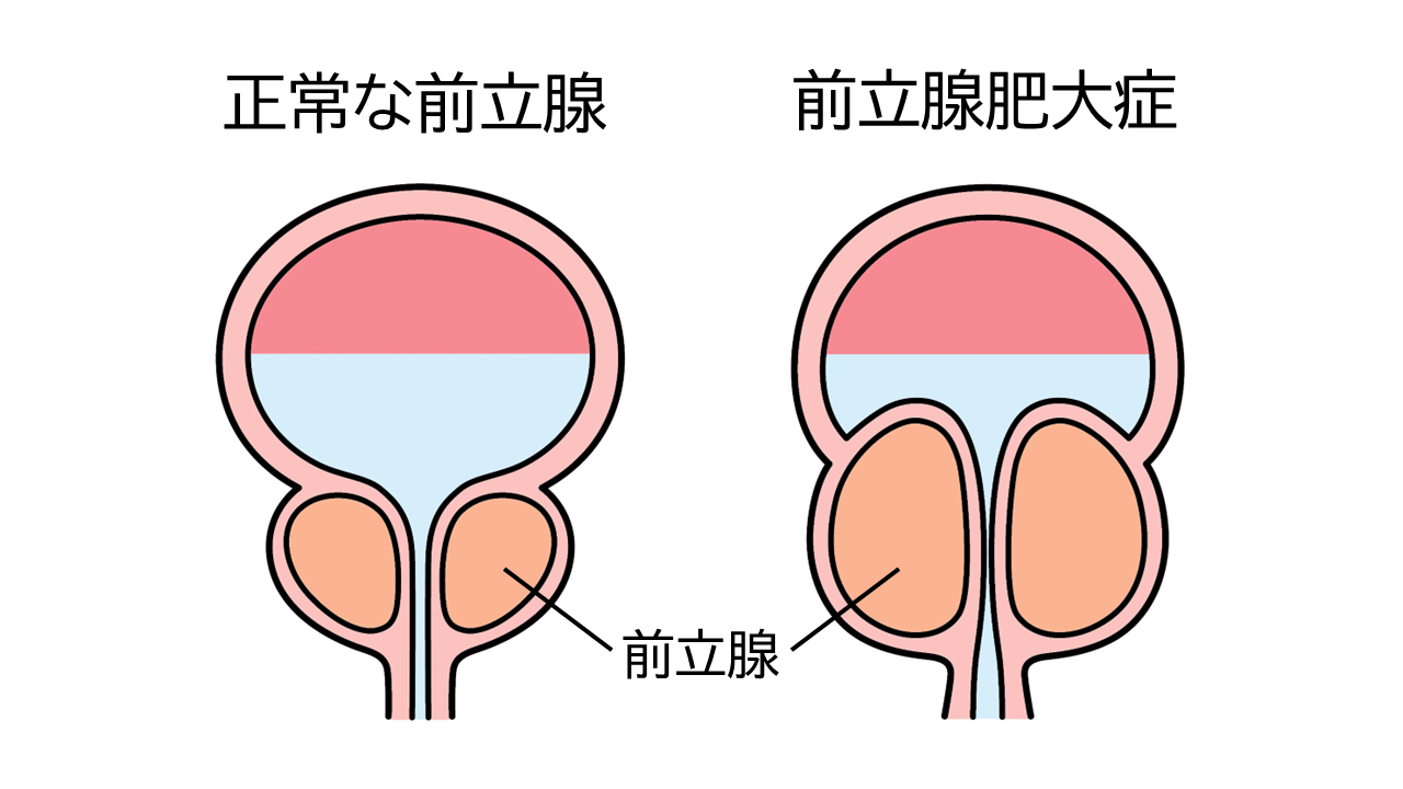 正常な前立腺と前立腺肥大症のイメージイラスト