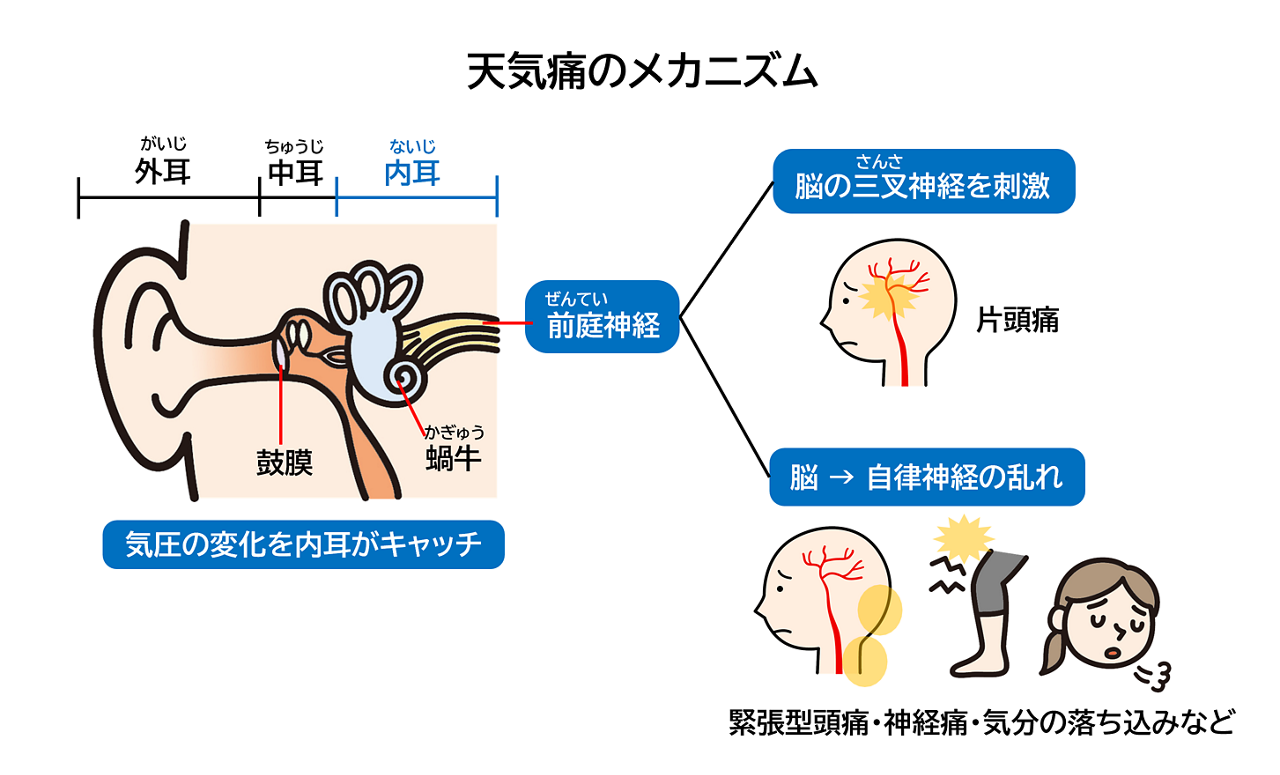 内耳が気圧の変化をキャッチすると、前庭神経から脳の三叉神経に刺激が伝わると、痛み物質が出て片頭痛が起こる。また、自律神経の乱れが起こると、緊張型頭痛、神経痛、気分の落ち込みなどが起こる。