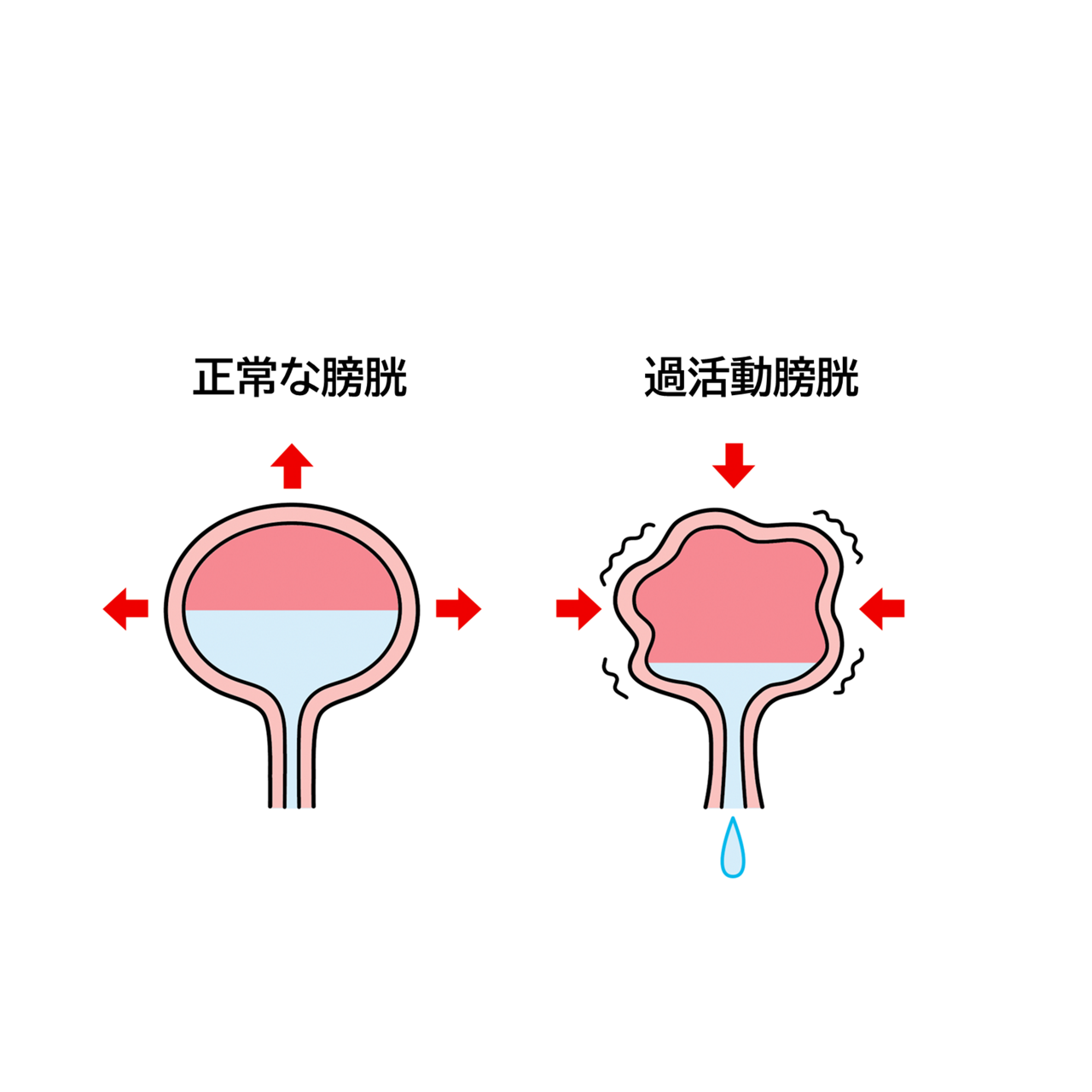 正常な膀胱と過活動膀胱のイメージイラスト
