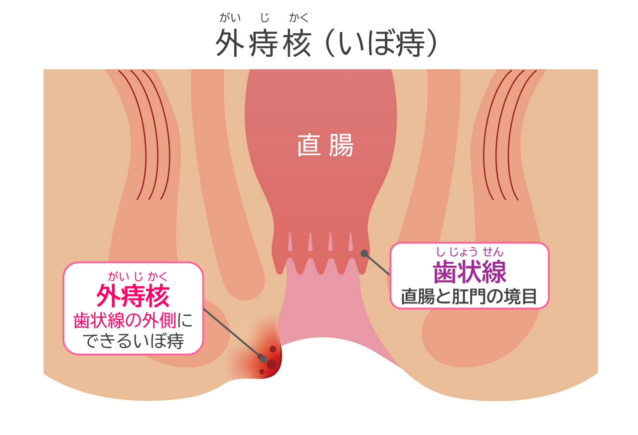 外痔核（いぼ痔）：直腸と肛門の境目の歯状線の外側にできるいぼ痔のイメージ図