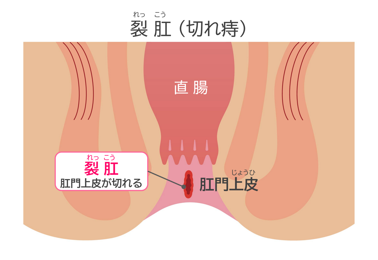切れ痔（裂肛）：肛門上部が切れるイメージ図