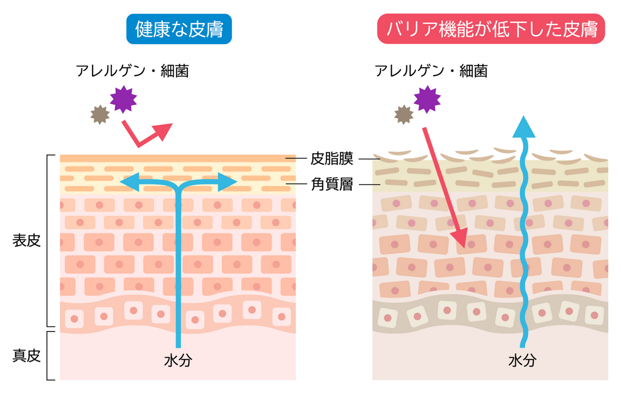 健康な皮膚とバリア機能が低下した皮膚を比較したイメージ図。健康な皮膚はアレルゲンや細菌を弾き水分を閉じ込めるが、バリア機能が低下した皮膚では、アレルゲンや細菌が入ってきてしまう。