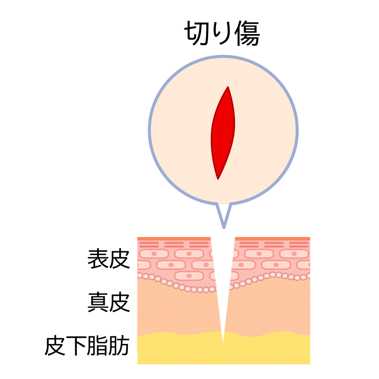 皮膚の表面（表皮）やその下の真皮が切れた状態。深くて範囲が狭く、断面が滑らかなイメージ図