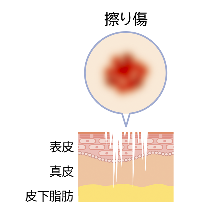 擦り傷は、皮膚の浅い部分が擦りむけて、皮膚の一部が剥がれた状態。傷の深さが均等ではなく、表皮が多く傷ついているイメージ図