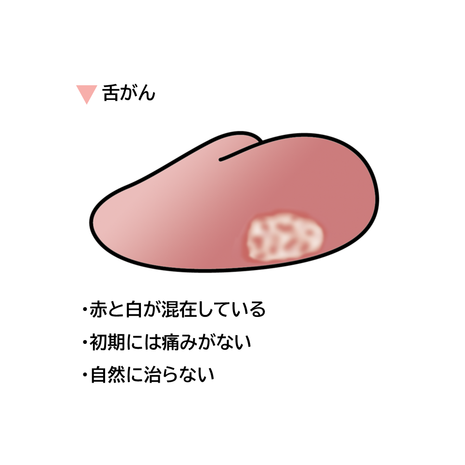 舌がんについてのイラスト。舌の表面に赤や白が混在する潰瘍やしこりが、初期には痛みがなく、自然に治らない特徴があります。