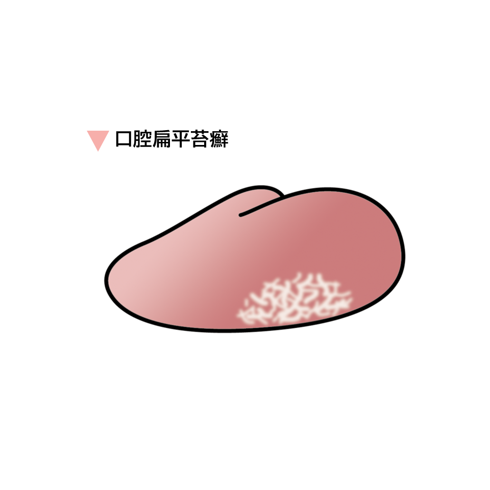 粘膜に白いレース状の模様やびらん、潰瘍が現れる口腔扁平苔癬のイメージ画像