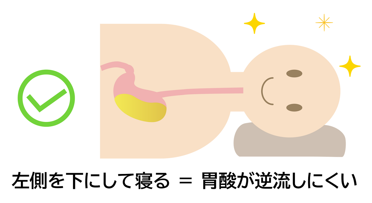 逆流性食道炎は就寝時に体の左側を下にして横向きで寝ると、胃酸が逆流しにくい。