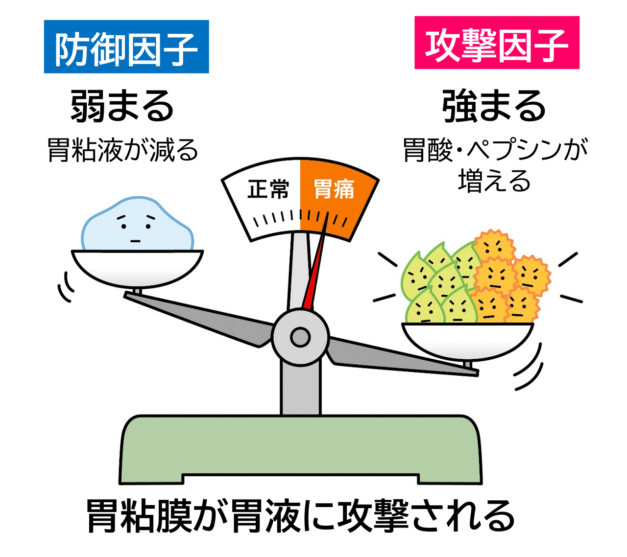 急性胃炎。胃液と胃粘液の分泌バランスが崩れ、胃液が胃粘膜を攻撃して炎症を起こす。