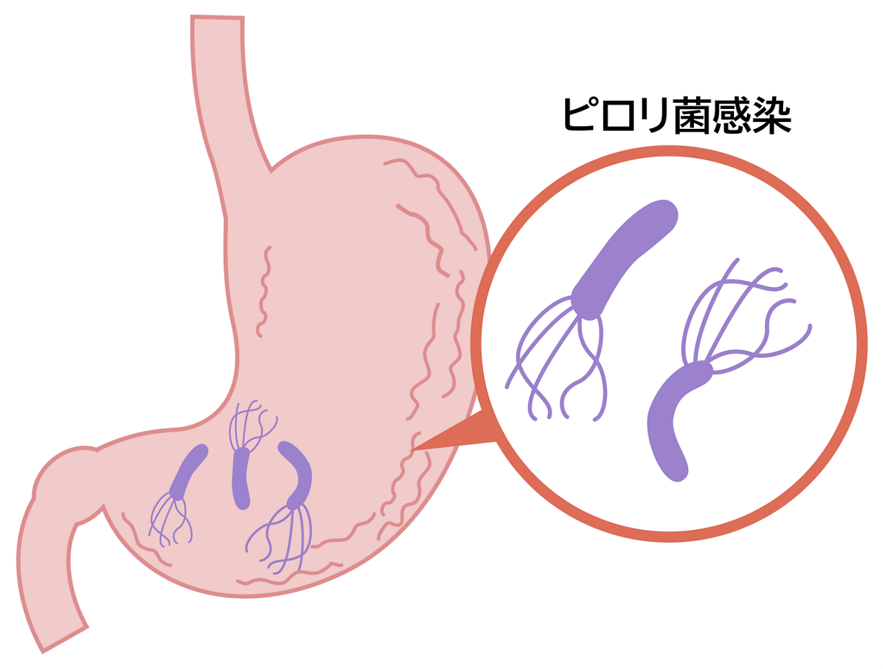 慢性胃炎の主な原因はピロリ菌の感染で、ピロリ菌が産生するアンモニアや毒素が胃粘膜を傷つける。