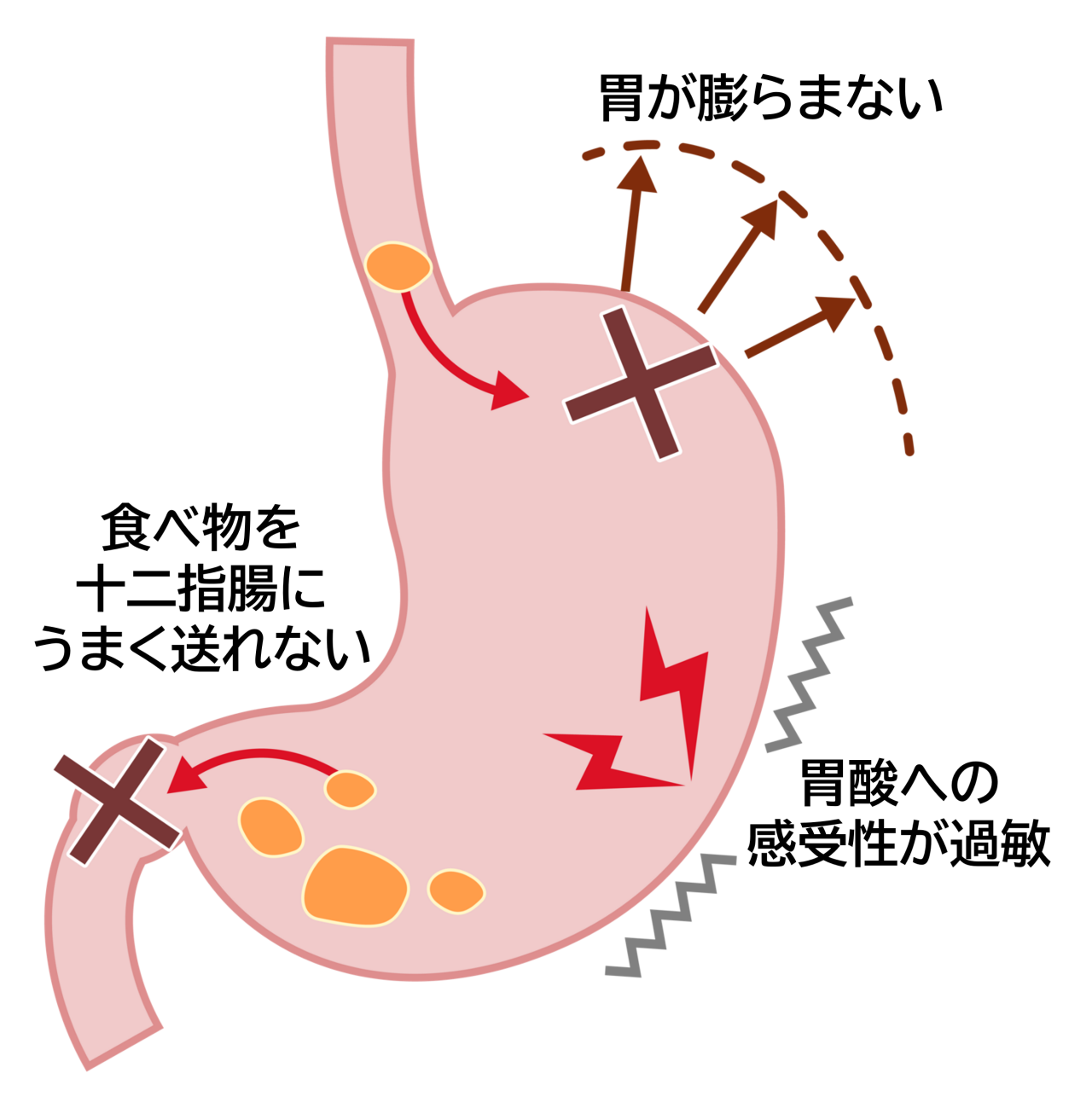 機能性ディスペプシア。食事をしても胃があまり膨らまないことや、胃酸への感受性が高まったりすること（胃酸過敏）、食べ物を十二指腸にうまく送れないことで起こる。
