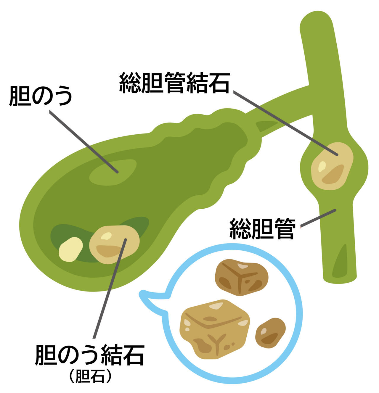 胆石（胆のう結石・総胆管結石）は、胆のうや胆管、肝臓にできる結石の総称。
