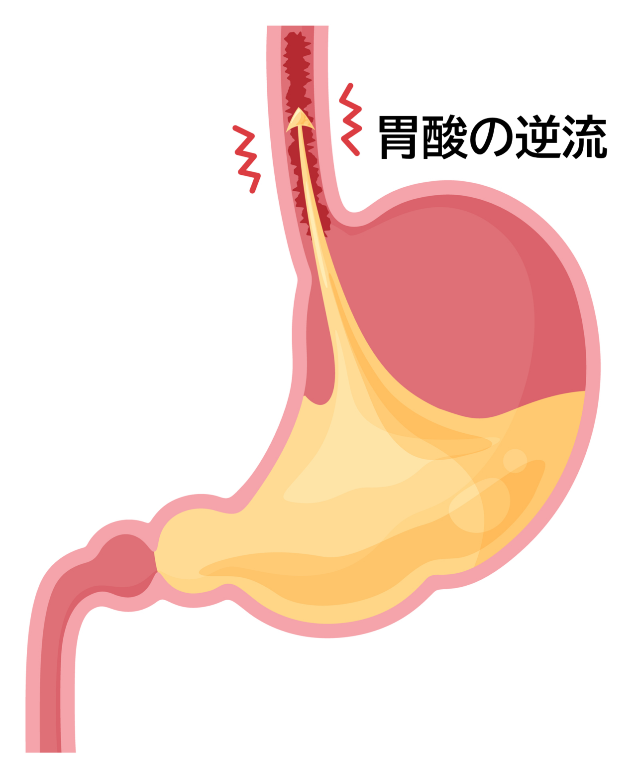 胃液が食道に逆流し、食道の粘膜に炎症やびらん、さらに深い傷（潰瘍）が生じる病気。