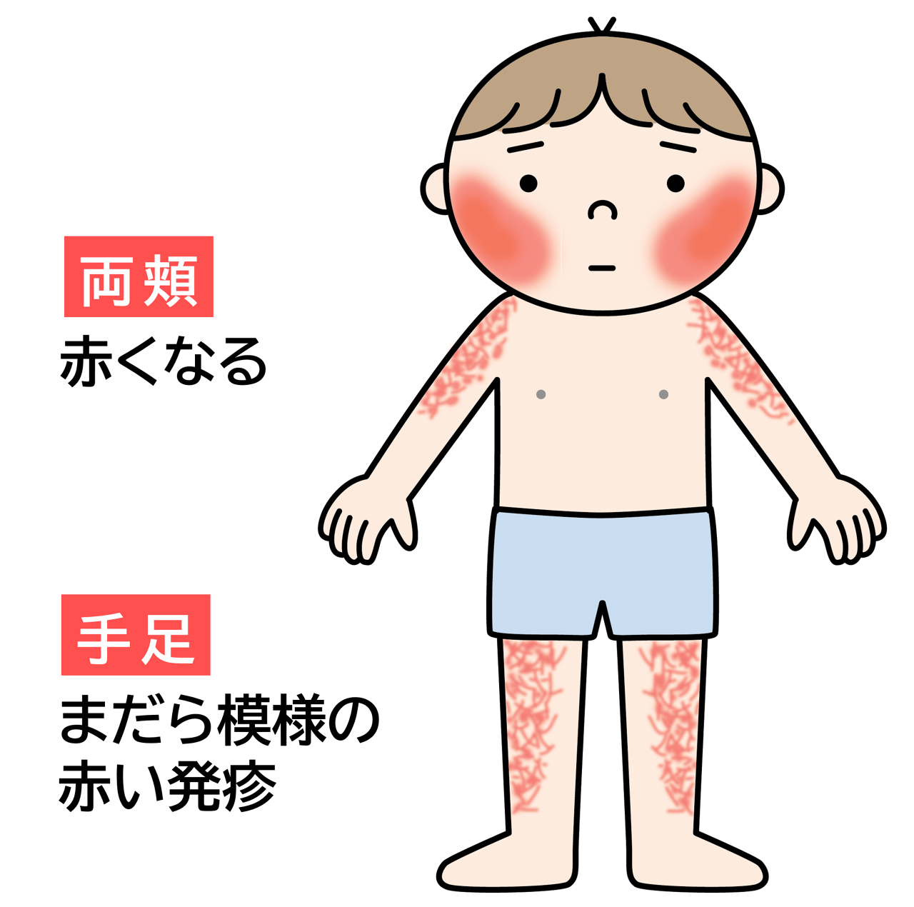 りんご病（伝染性紅斑）は両頬が赤くなり手足にまだら模様の赤い発疹ができる。