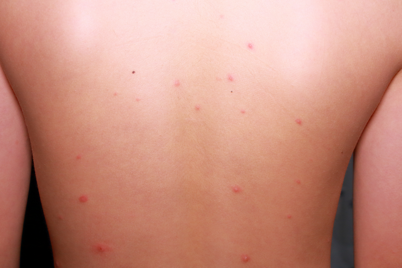 水ぼうそう(水痘)