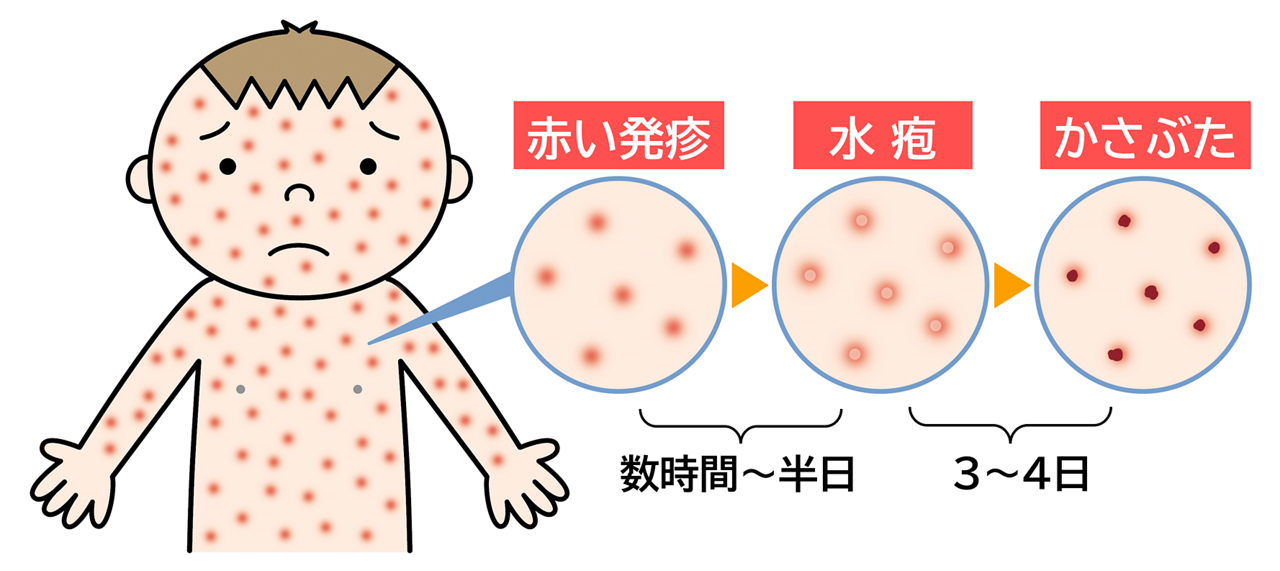 水ぼうそう(水痘)は、2~3週間の潜伏期間の後に、強いかゆみを伴う直径2~3mmの赤い発疹が全身に広がり、数時間から半日の間に次々と透明な水疱(すいほう:水ぶくれ)に変わっていき、さらに水疱は3~4日で乾き、かさぶたになります。