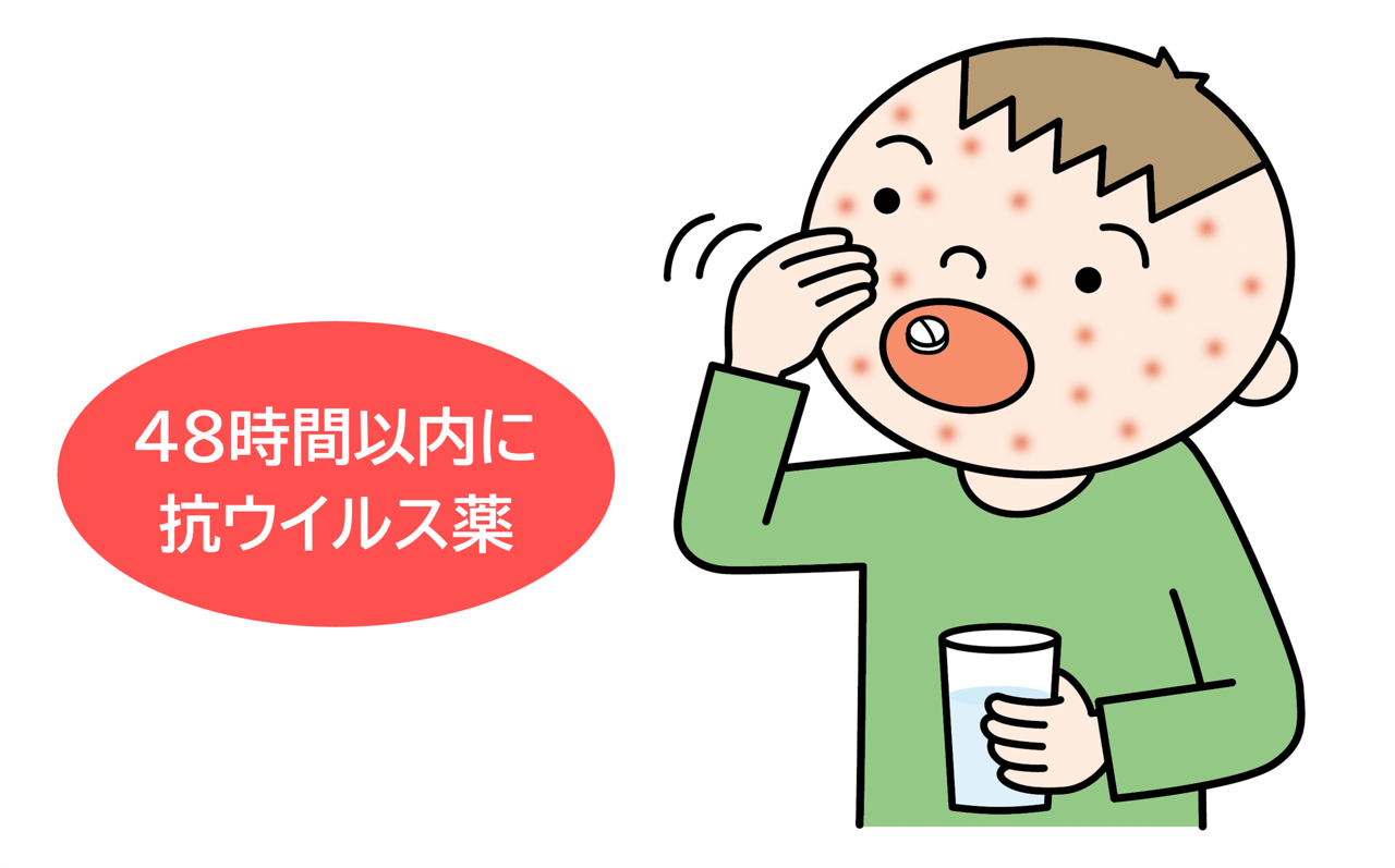 水ぼうそう(水痘)の治療には抗ウイルス薬があります。発症後、48時間以内に抗ウイルス薬で治療を始めると症状が軽く済み、治癒を早めることができるので、早めの受診が大切です。