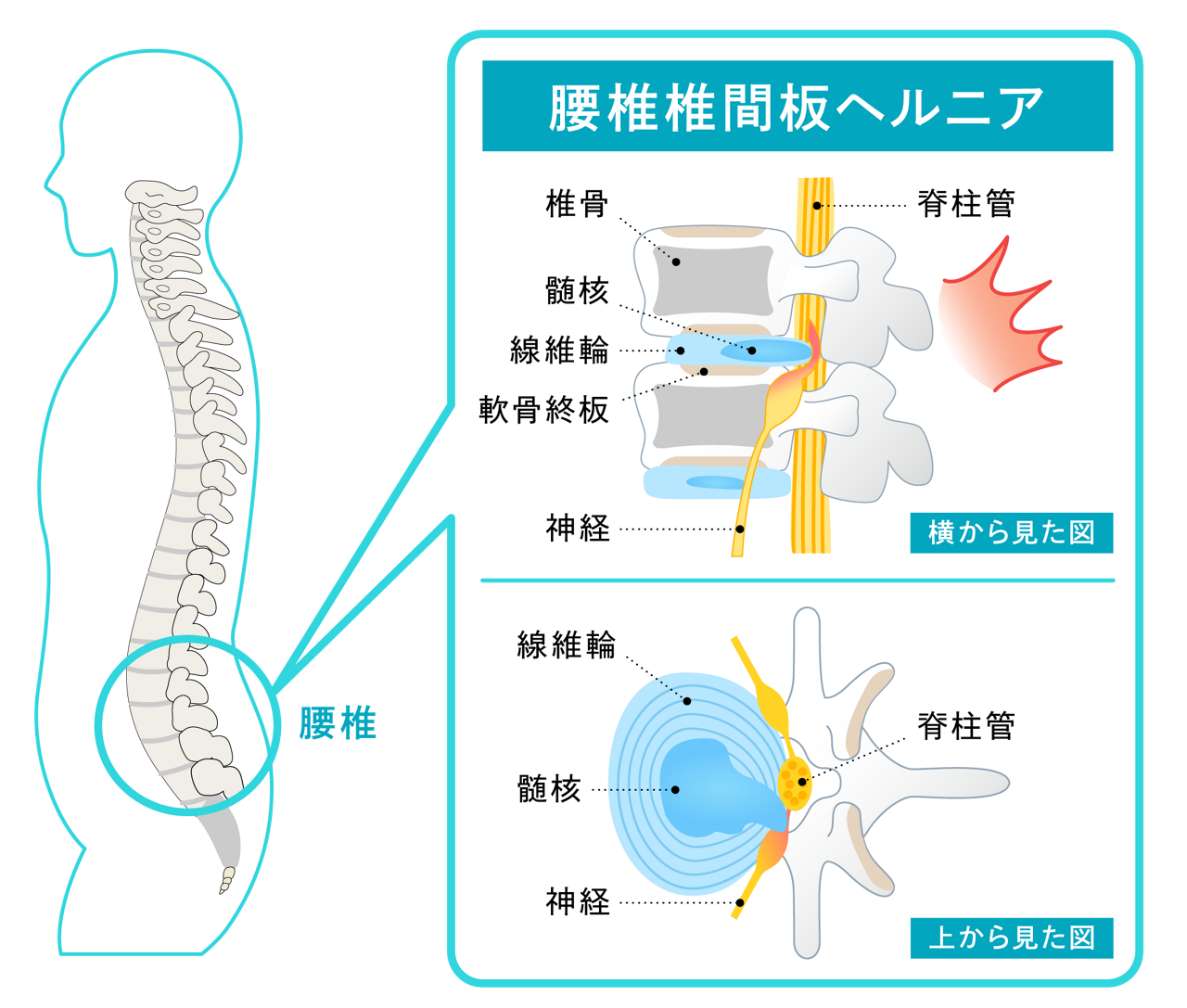線維輪が徐々に弾力を失って亀裂が入り、髄核の一部が外に飛び出した、腰椎椎間板ヘルニアのイメージイラスト