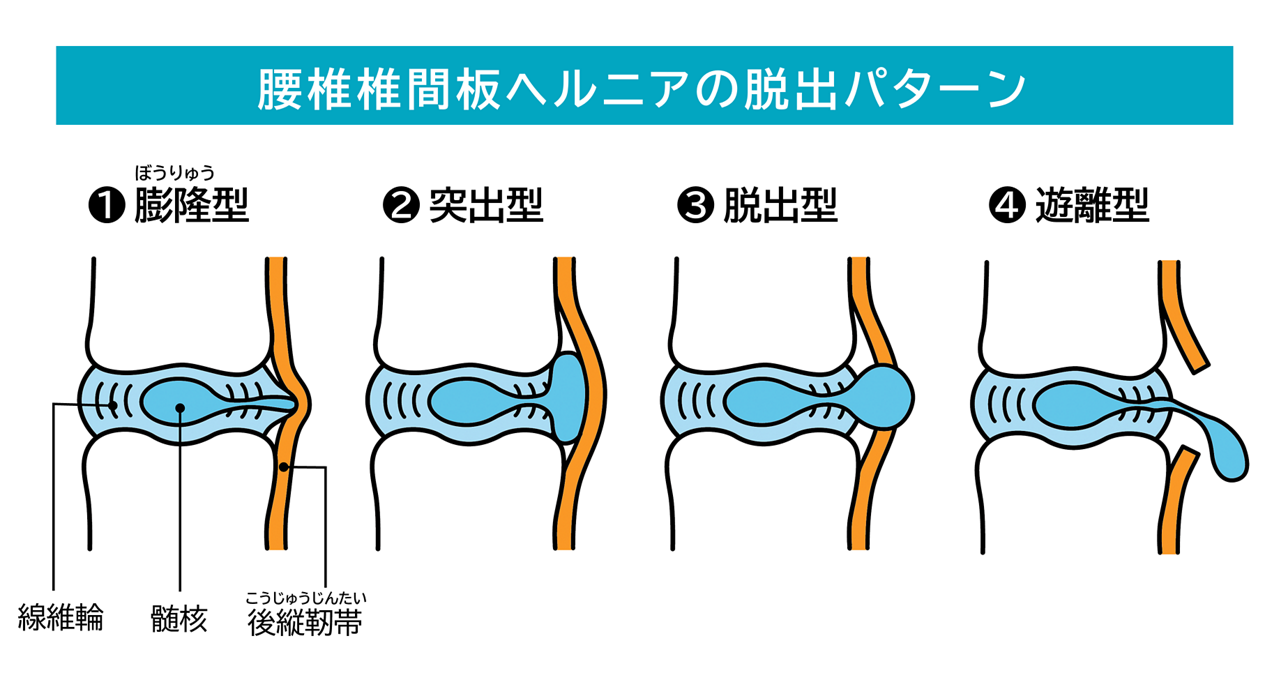 腰椎椎間板ヘルニアの脱出パターン。① 膨隆（ぼうりゅう）型…髄核が線維輪の中に留まった状態。② 突出型…髄核が線維輪から飛び出しているが、後縦靭帯の中には留まった状態。③ 脱出型…髄核がさらに外側に飛び出し、後縦靭帯も突破して脱出した状態。④ 遊離型…飛び出した髄核がちぎれて、他の場所に移動した状態。