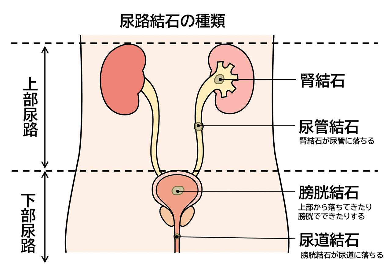尿路結石の種類は、上部尿路にできる腎結石・尿管結石（腎結石が尿管に落ちる）、下部尿路にできる膀胱結石（上部から落ちてきたり膀胱でできたりする）・尿道結石（膀胱結石が尿道に落ちる）があります。