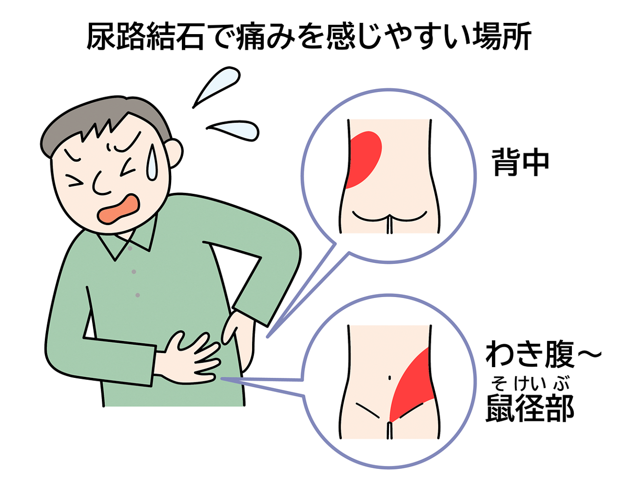 尿路結石で痛みを感じやすい場所は、背中やわき腹から鼠径部にかけてです。